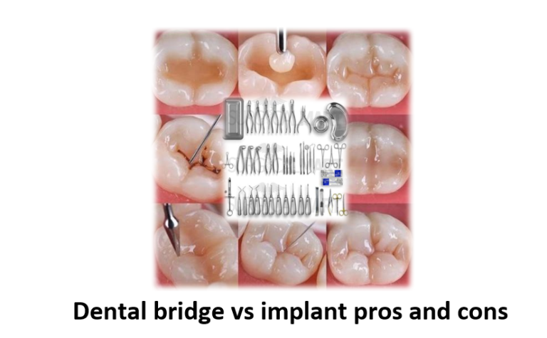 Dental bridge vs implant pros and cons