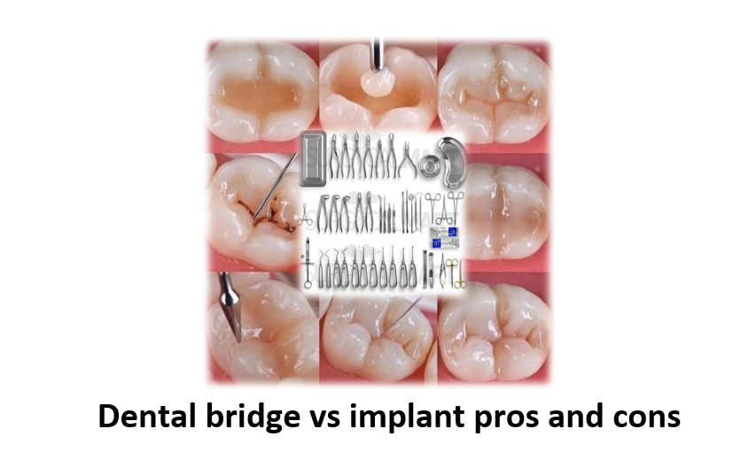 Dental bridge vs implant pros and cons